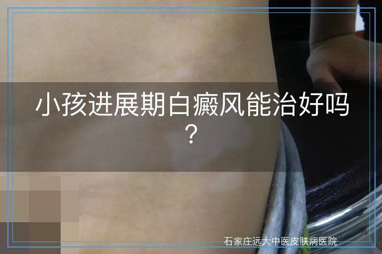 小孩进展期白癜风能治好吗？