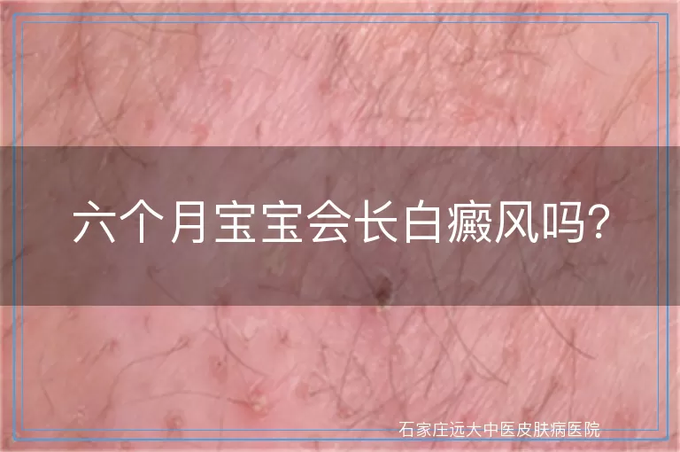 六个月宝宝会长白癜风吗？