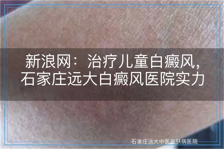 新浪网：治疗儿童白癜风，石家庄远大白癜风医院实力更强