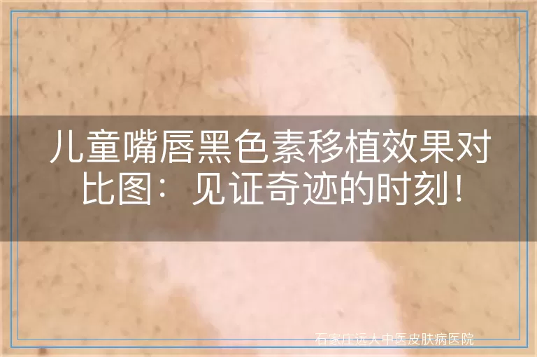 儿童嘴唇黑色素移植效果对比图：见证奇迹的时刻！