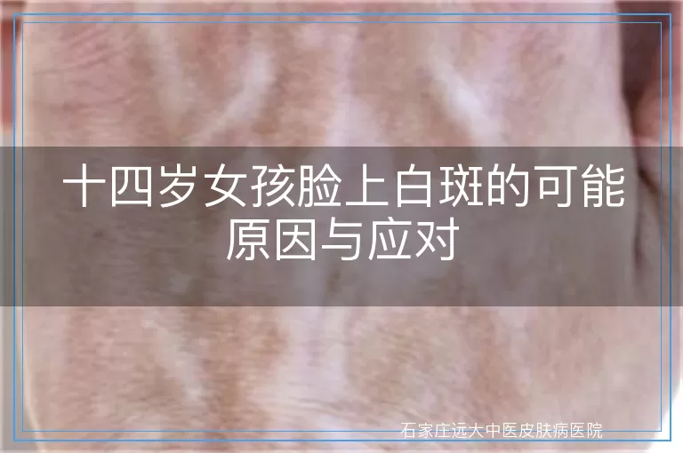 十四岁女孩脸上白斑的可能原因与应对