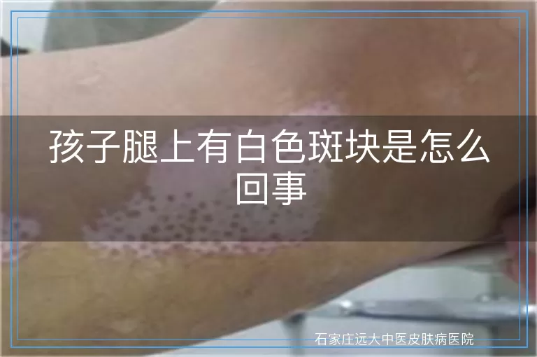 孩子腿上有白色斑块是怎么回事