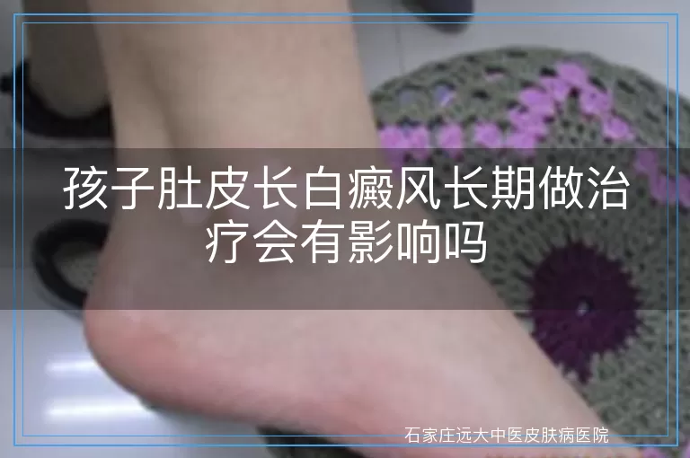孩子肚皮长白癜风长期做治疗会有影响吗