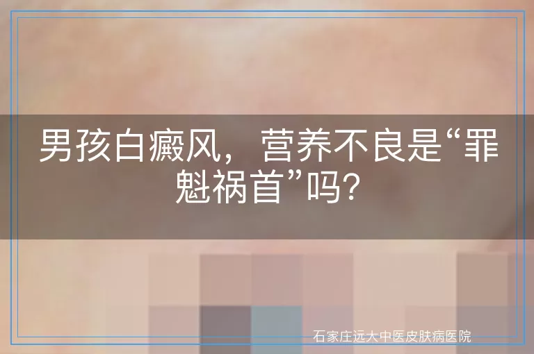 男孩白癜风，营养不良是“罪魁祸首”吗？