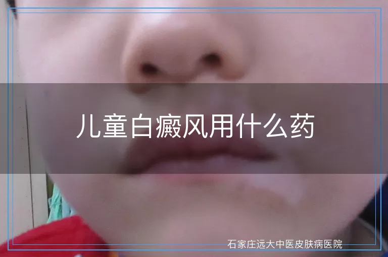 儿童白癜风用什么药