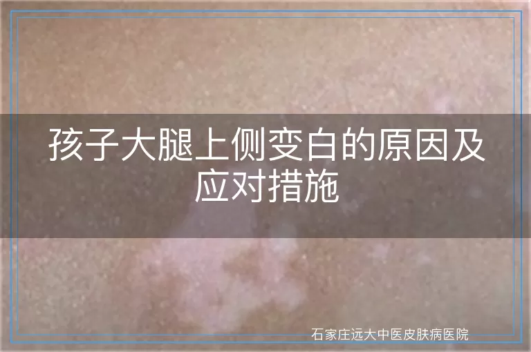 孩子大腿上侧变白的原因及应对措施