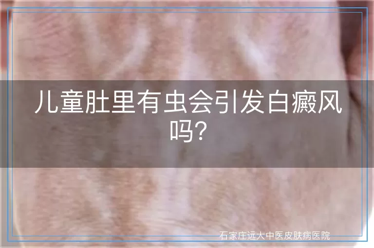 儿童肚里有虫会引发白癜风吗？