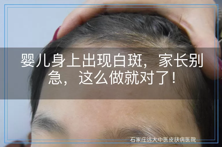 婴儿身上出现白斑，家长别急，这么做就对了！