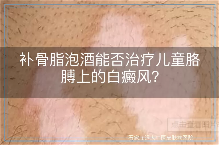 补骨脂泡酒能否治疗儿童胳膊上的白癜风？