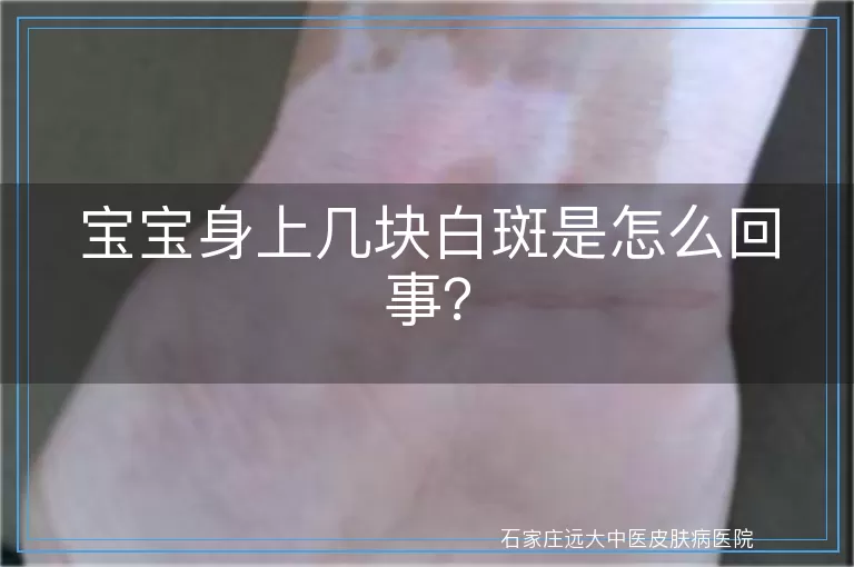 宝宝身上几块白斑是怎么回事？