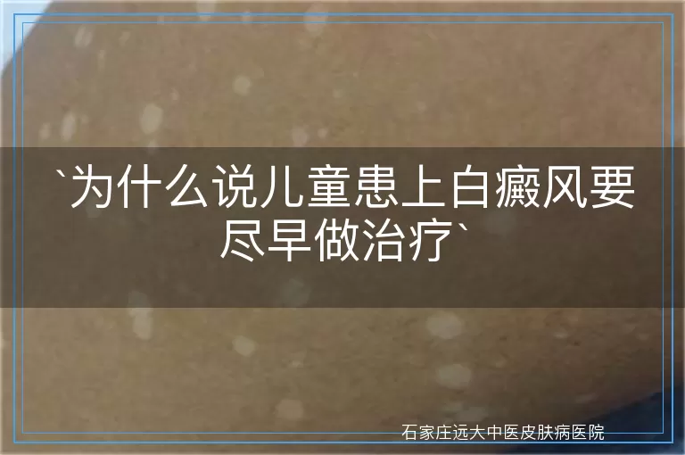 为什么说儿童患上白癜风要尽早做治疗