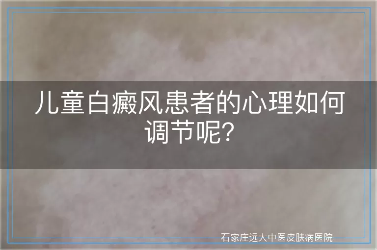 儿童白癜风患者的心理如何调节呢？