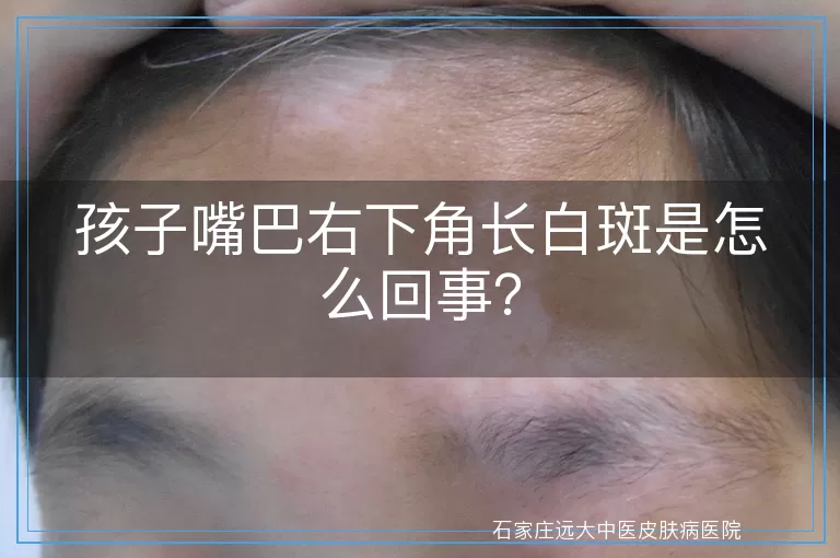 孩子嘴巴右下角长白斑是怎么回事？