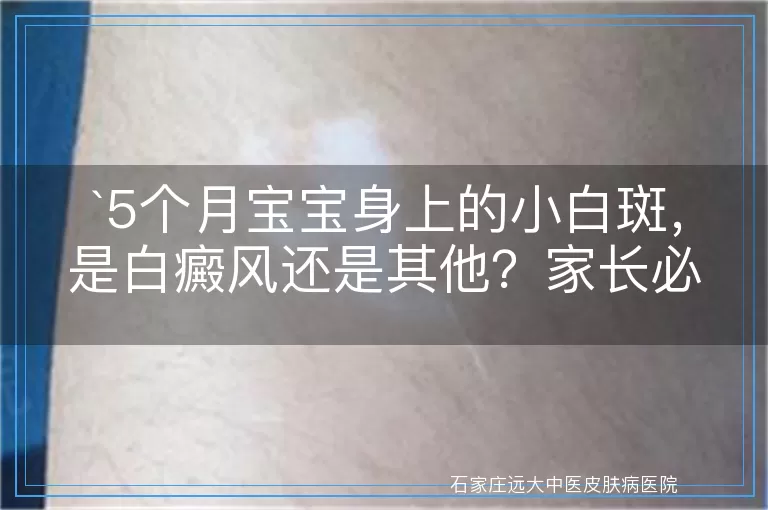 5个月宝宝身上的小白斑，是白癜风还是其他？家长必看！