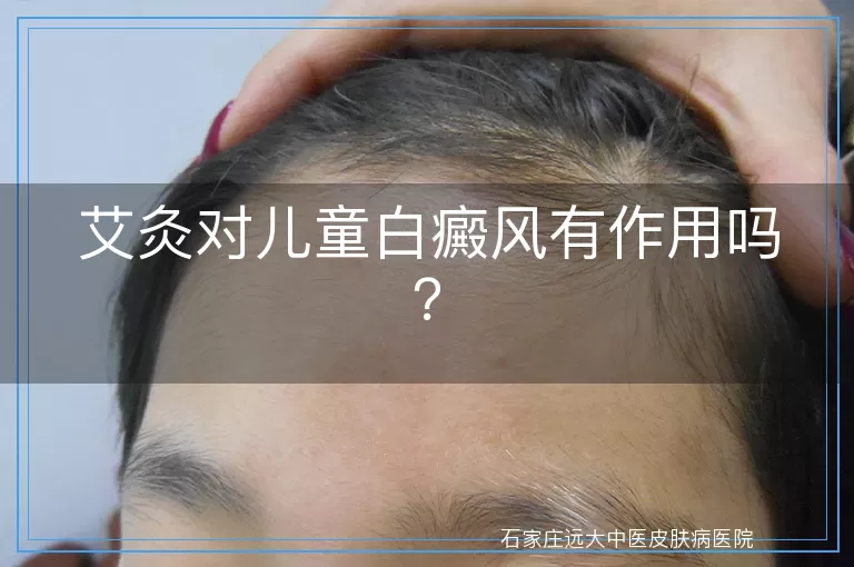 艾灸对儿童白癜风有作用吗？