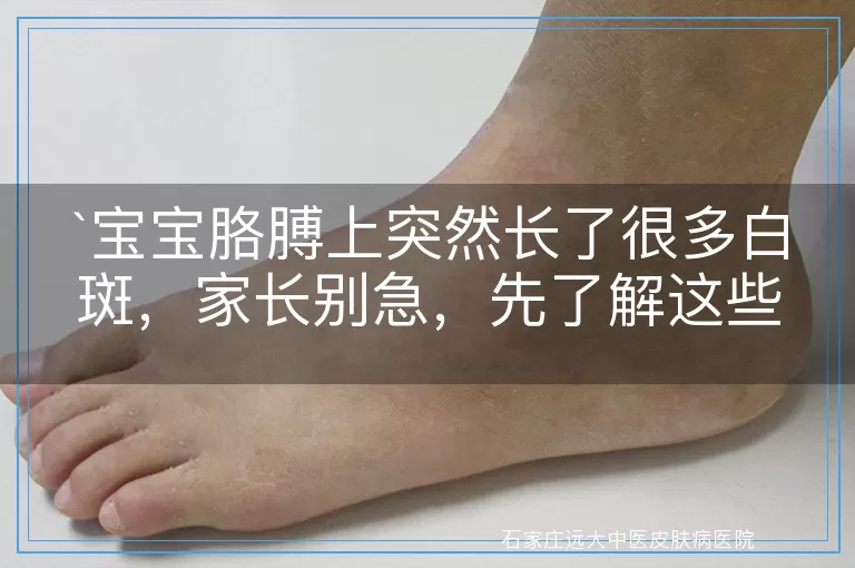 宝宝胳膊上突然长了很多白斑,家长别急,先了解这些!