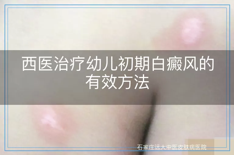 西医治疗幼儿初期白癜风的有效方法