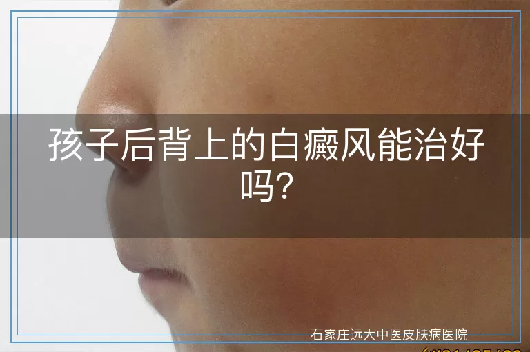 孩子后背上的白癜风能治好吗？