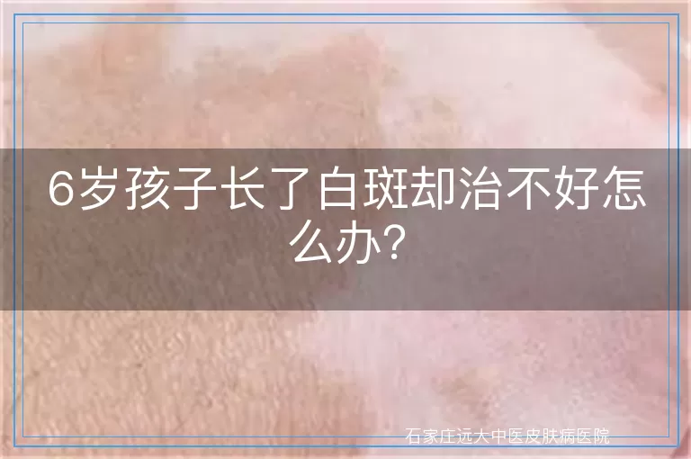 6岁孩子长了白斑却治不好怎么办？