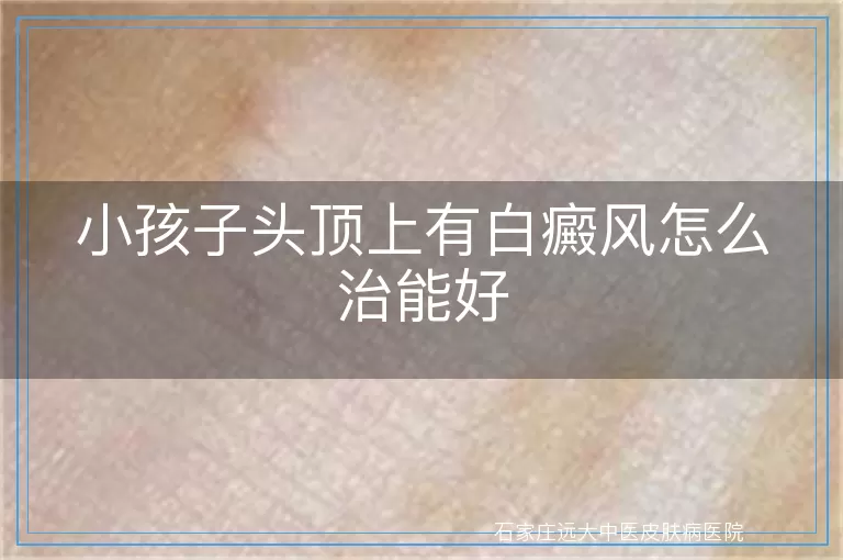小孩子头顶上有白癜风怎么治能好