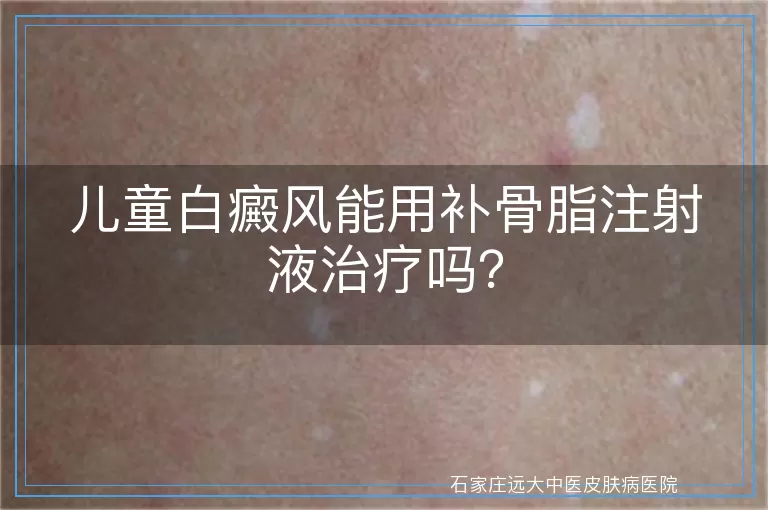 儿童白癜风能用补骨脂注射液治疗吗？