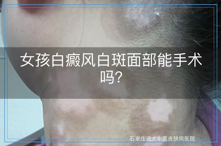 女孩白癜风白斑面部能手术吗？