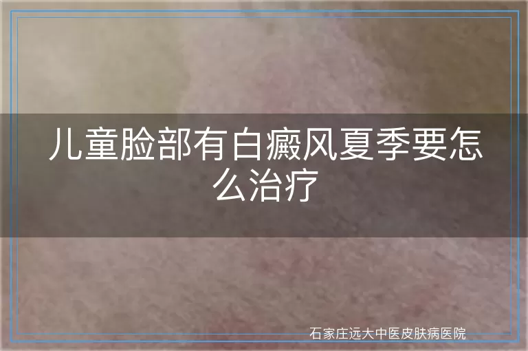 儿童脸部有白癜风夏季要怎么治疗