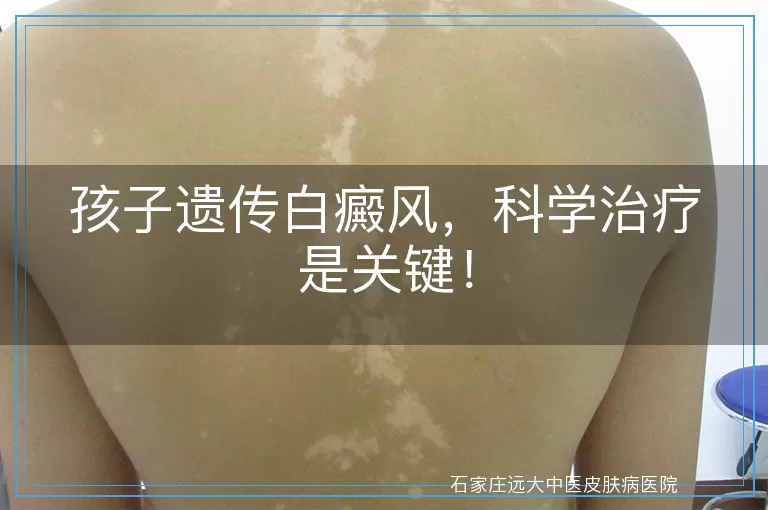 孩子遗传白癜风，科学治疗是关键！