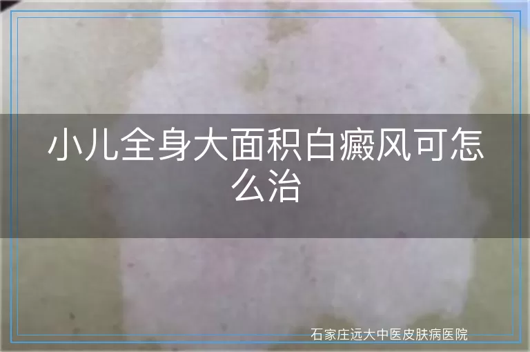 小儿全身大面积白癜风可怎么治