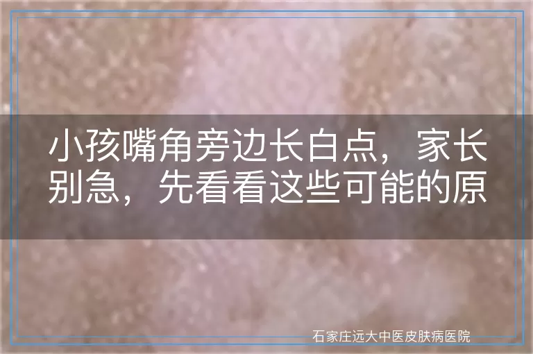 小孩嘴角旁边长白点,家长别急,先看看这些可能的原因