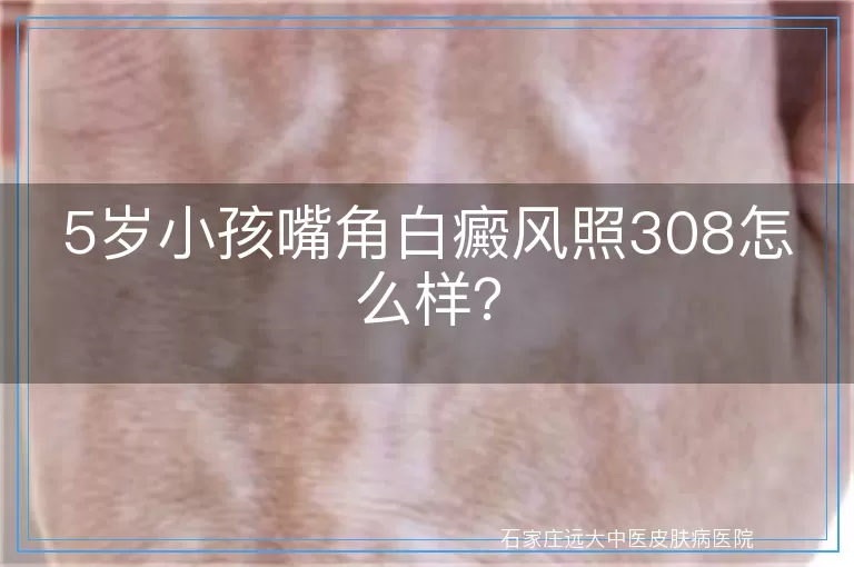 5岁小孩嘴角白癜风照308怎么样？