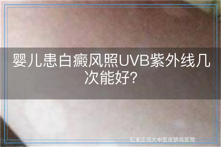 婴儿患白癜风照UVB紫外线几次能好？