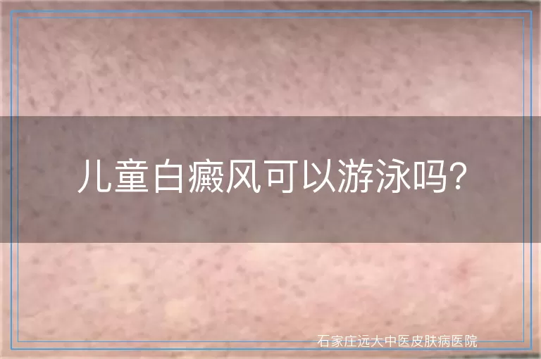 儿童白癜风可以游泳吗？