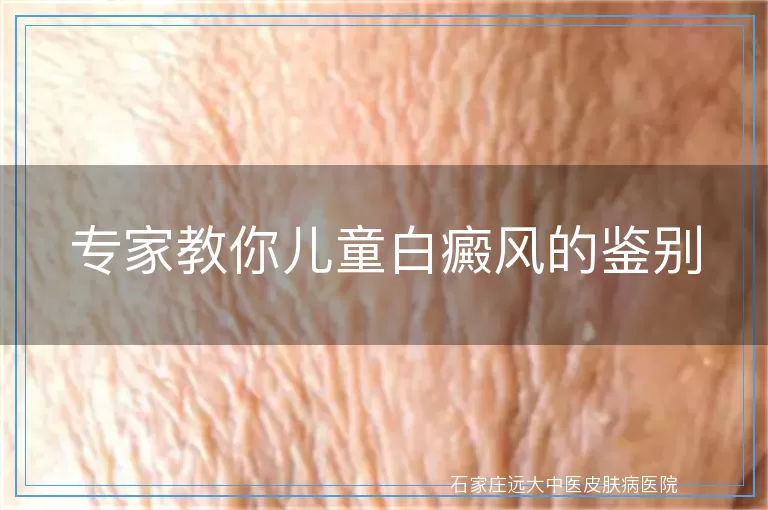 专家教你儿童白癜风的鉴别