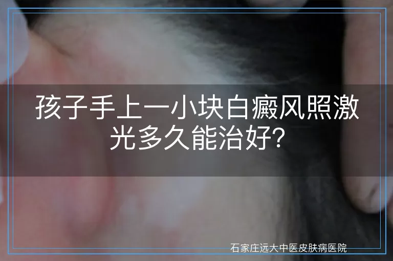 孩子手上一小块白癜风照激光多久能治好？
