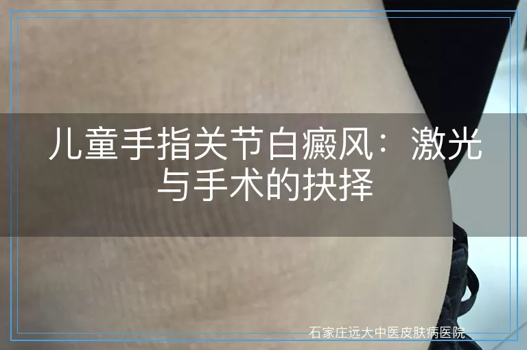 儿童手指关节白癜风：激光与手术的抉择