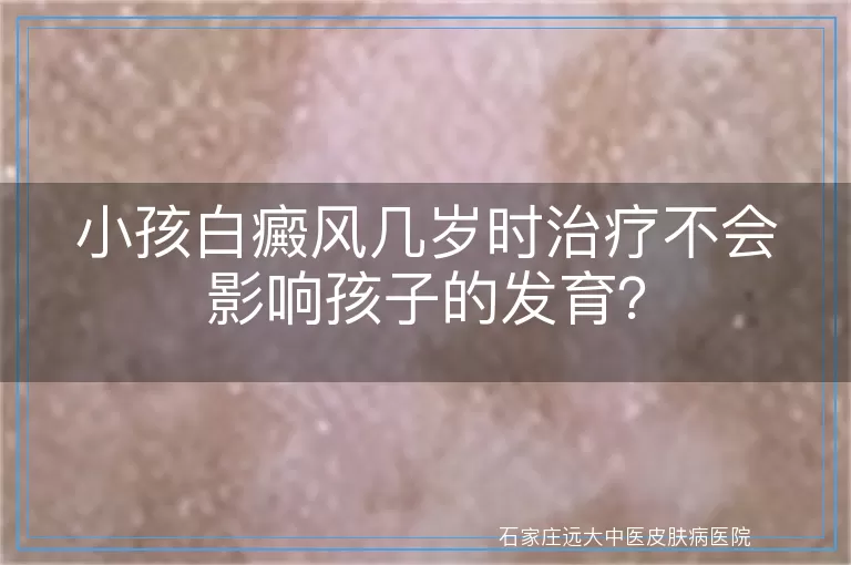 小孩白癜风几岁时治疗不会影响孩子的发育？