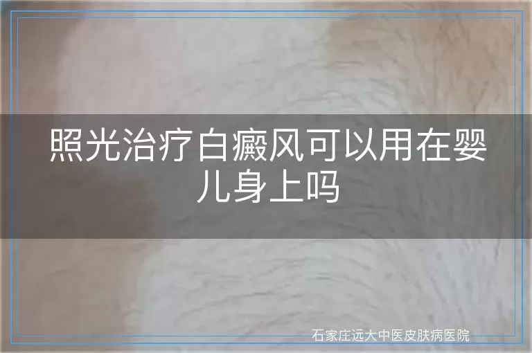 照光治疗白癜风可以用在婴儿身上吗