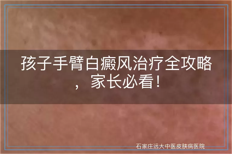 孩子手臂白癜风治疗全攻略，家长必看！