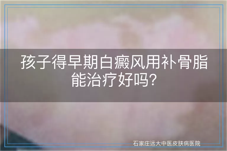孩子得早期白癜风用补骨脂能治疗好吗？