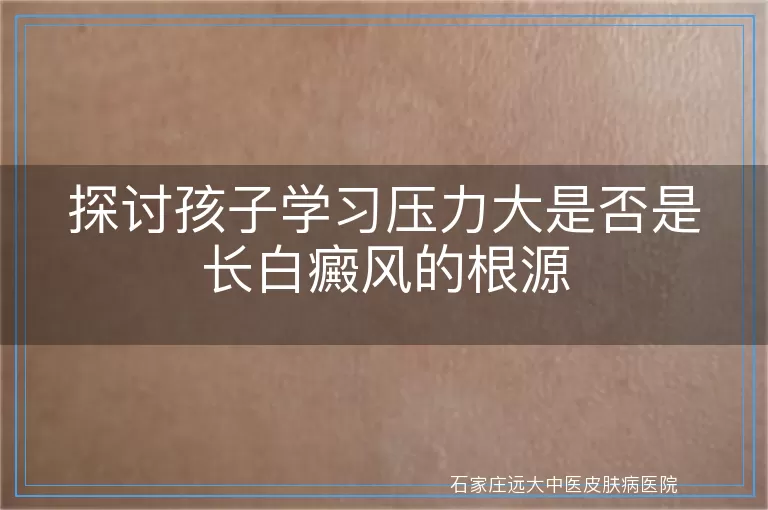 探讨孩子学习压力大是否是长白癜风的根源