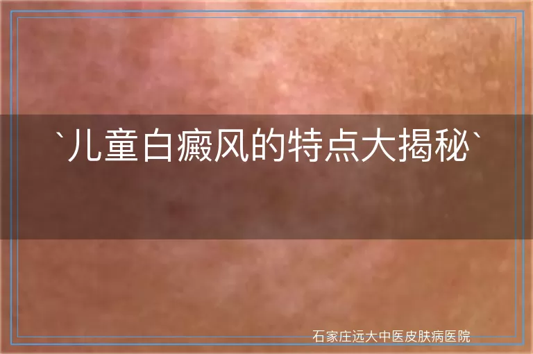 儿童白癜风的特点大揭秘
