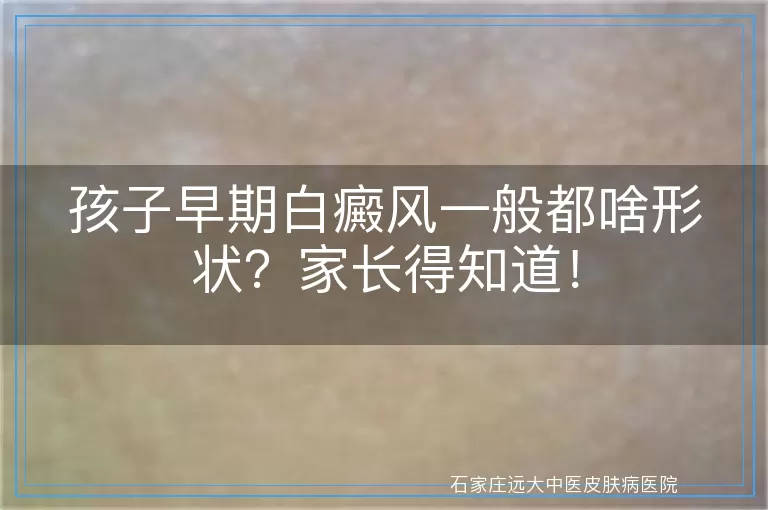 孩子早期白癜风一般都啥形状？家长得知道！