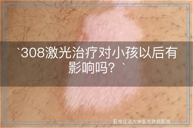 308激光治疗对小孩以后有影响吗？