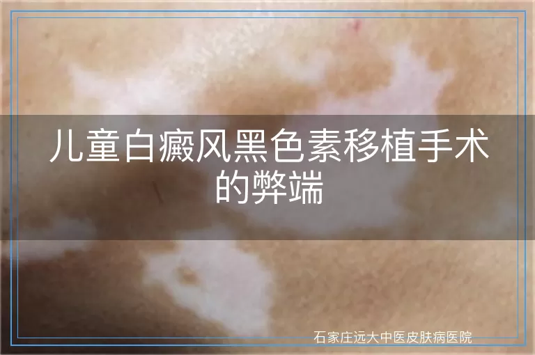 儿童白癜风黑色素移植手术的弊端