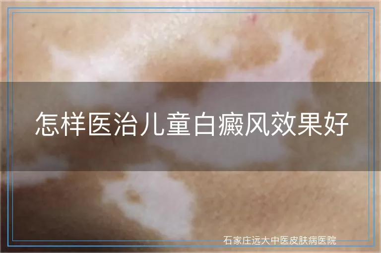 怎样医治儿童白癜风效果好