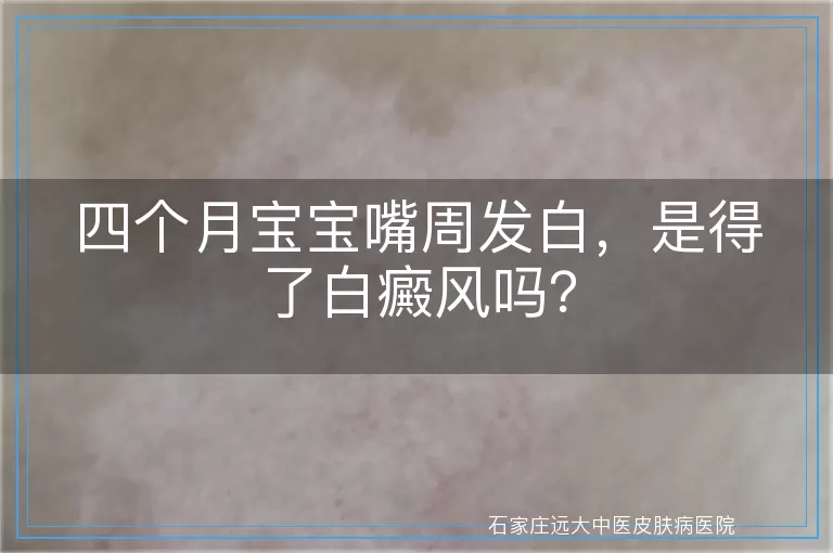 四个月宝宝嘴周发白，是得了白癜风吗？