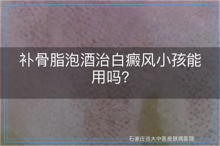 补骨脂泡酒治白癜风小孩能用吗？