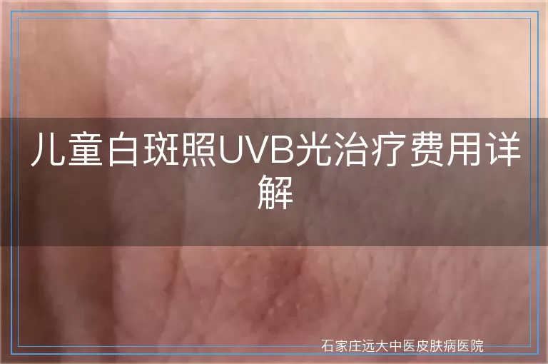 儿童白斑照UVB光治疗费用详解