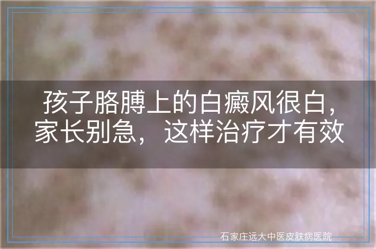 孩子胳膊上的白癜风很白，家长别急，这样治疗才有效！